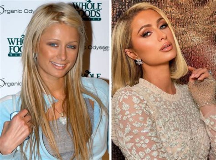 Did Cosmetic Surgery Transform Paris Hilton's Iconic Look?