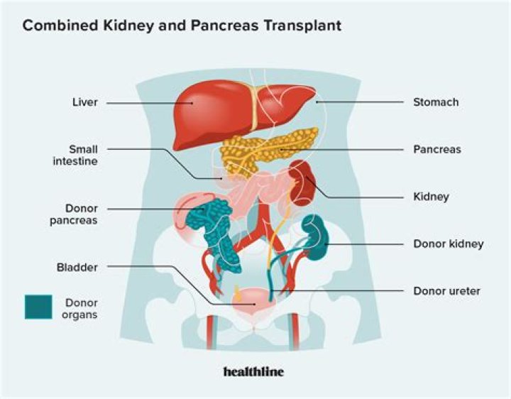 Kidney Transplant Scars: Causes, Treatment Options, And Prevention